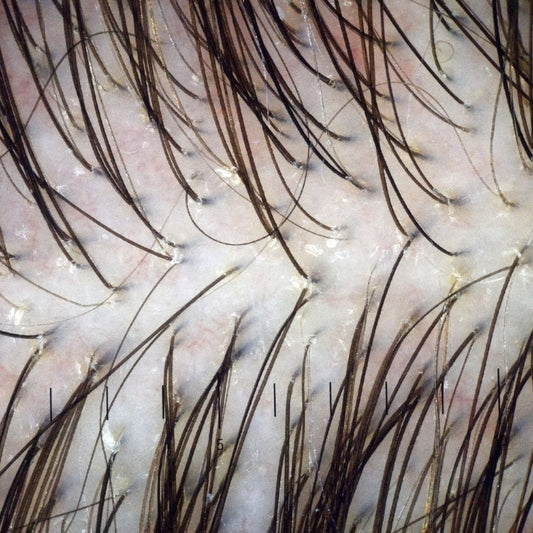 Diagnostic du cuir chevelu